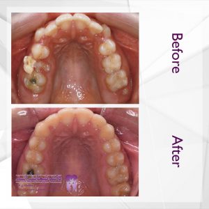 نمونه ارتودنسی ثابت شماره 70