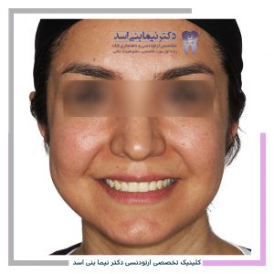 نمونه ارتودنسی ثابت شماره 93