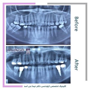 نمونه ارتودنسی ثابت شماره 104