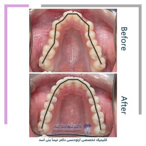 نمونه ارتودنسی ثابت شماره 119