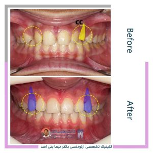 نمونه ارتودنسی ثابت شماره 123